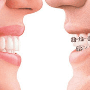 Orthodontic and Invisalign