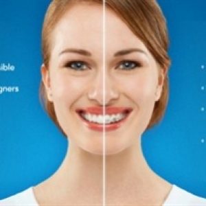 invisalign