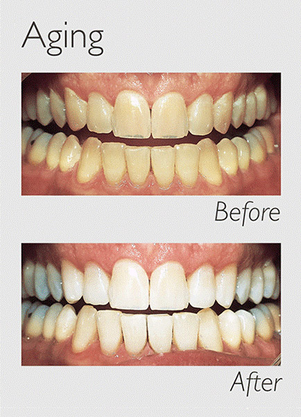 Teeth Whitening Aging Image