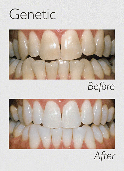 Teeth Whitening Genetic Image teeth whitening genetic image