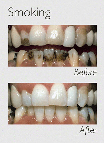 Teeth Whitening Smoking Image teeth whitening smoking image