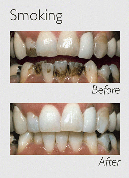 teeth whitening smoking image