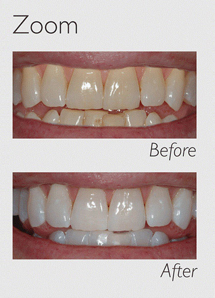 teeth whitening zoom image 1